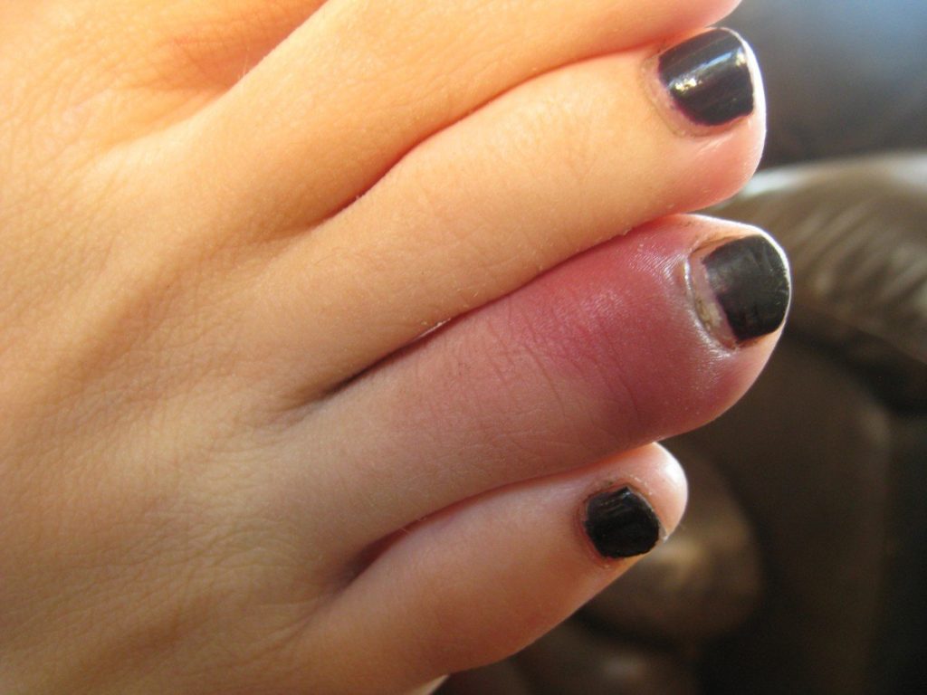 how-to-mend-a-broken-toe-at-home-frugally-sustainable