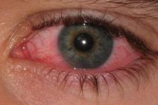 Natural Treatment of Conjunctivitis (Pink Eye)